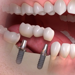 Implantes de carga inmediata en Clínica Dental Díez - tu dentista de confianza en Madrid Legazpi